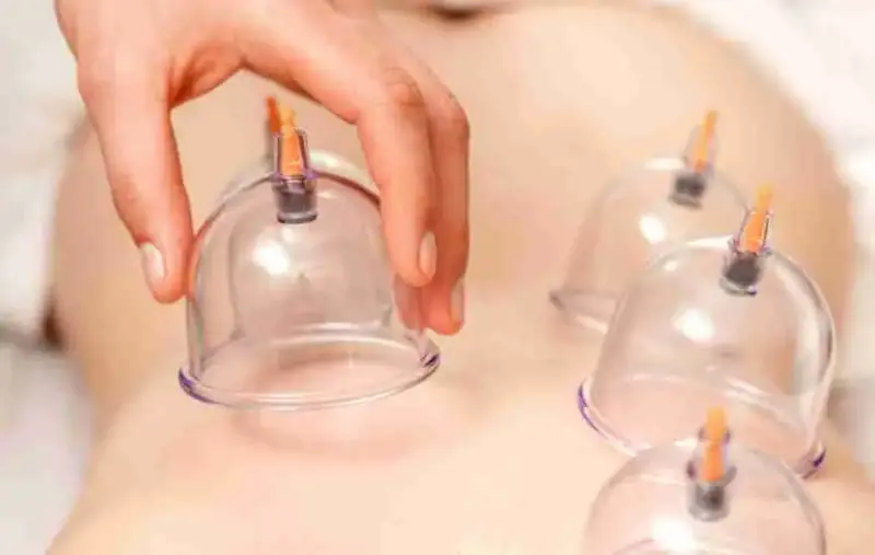 Cupping Therapy Massage Cups on a patients back